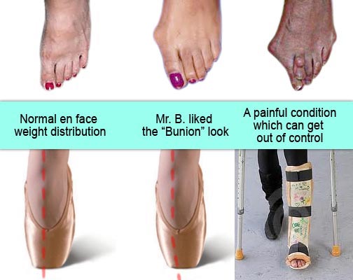 Problems Related To Dancing En Pointe